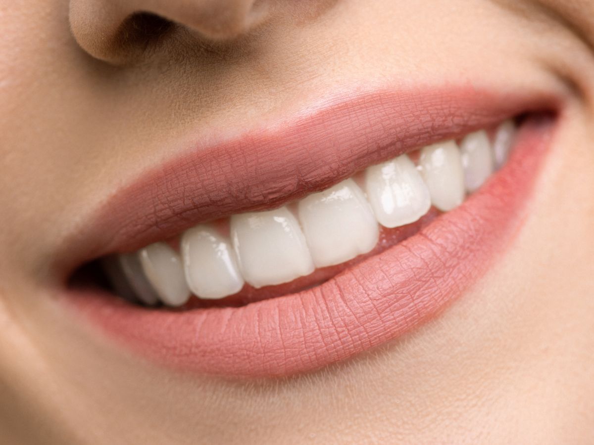 Lamine veneer yaprak porselen ile gülüş dönüşümü